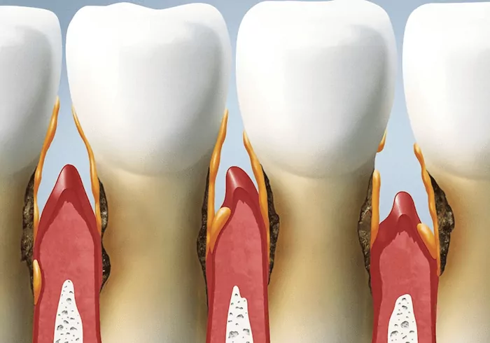 Симптомы пародонтита