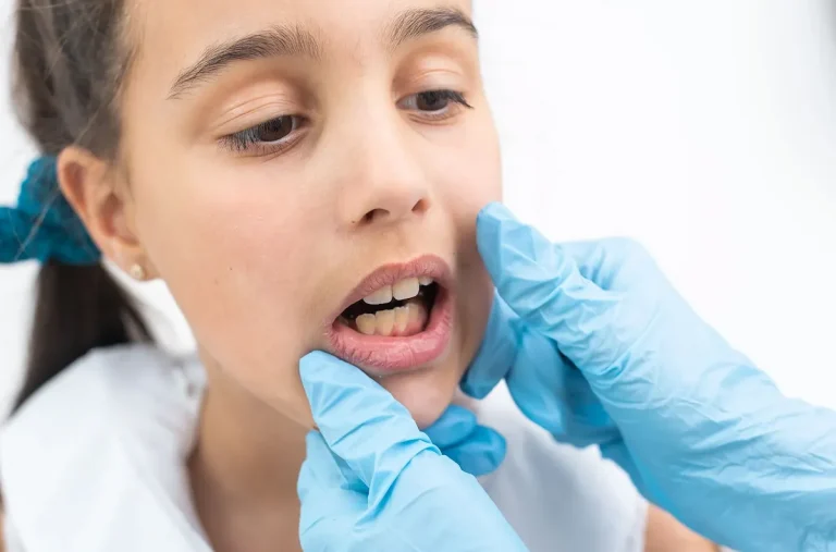 Гінгівіт у дітей: симптоми, причини та ефективне лікування